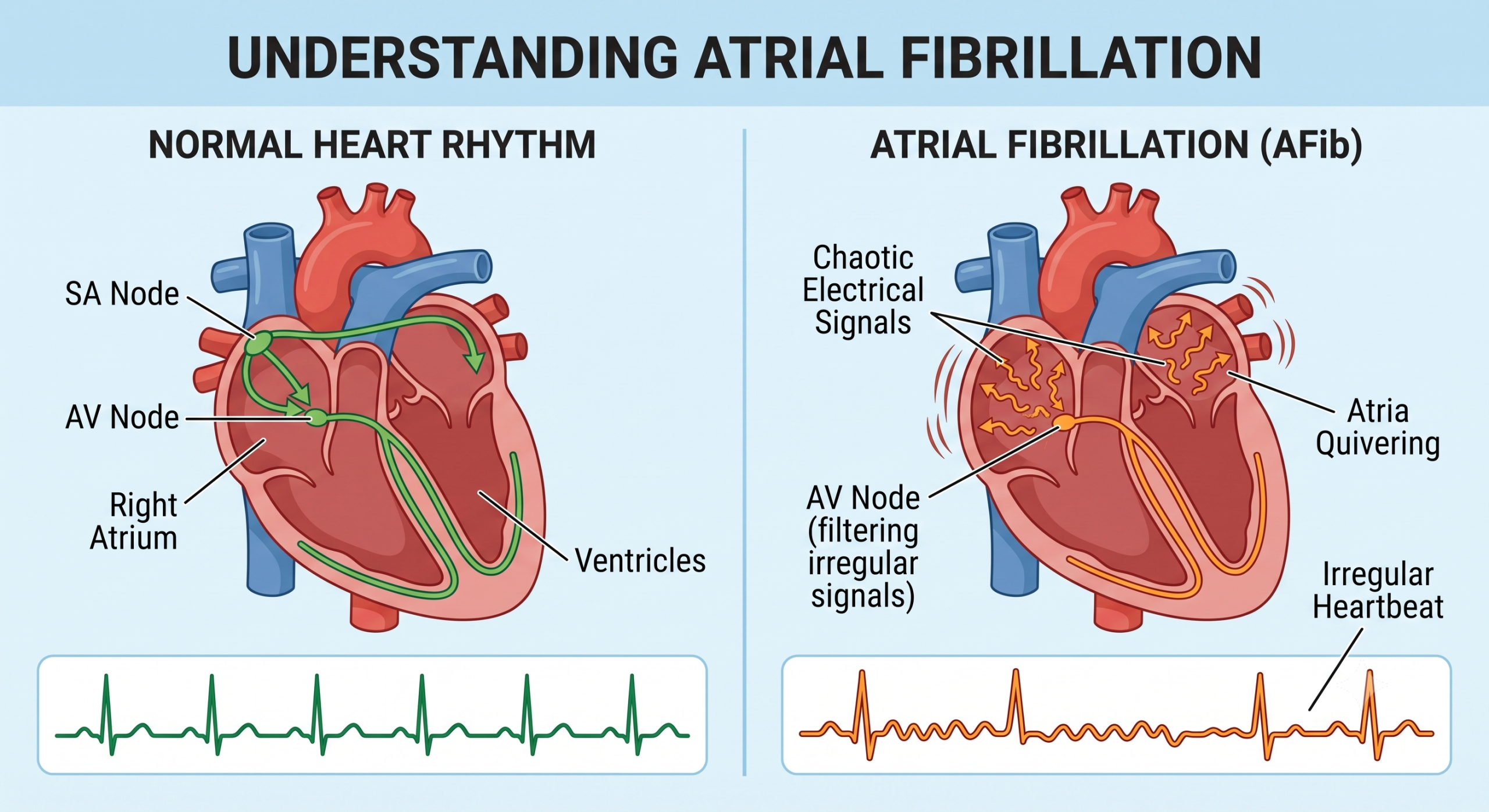 Atrial Fibrillation diagram